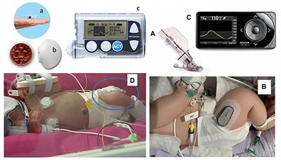 Should continuous glucose monitoring be used to manage neonates at risk of hypoglycaemia?